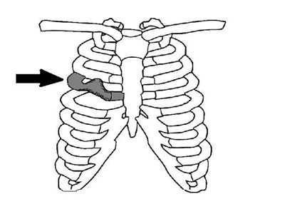 假性鸡胸:单根肋骨前凸畸形186194年前