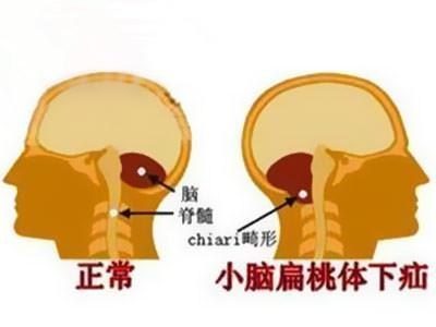 小腦扁桃體下疝畸形的手術治療