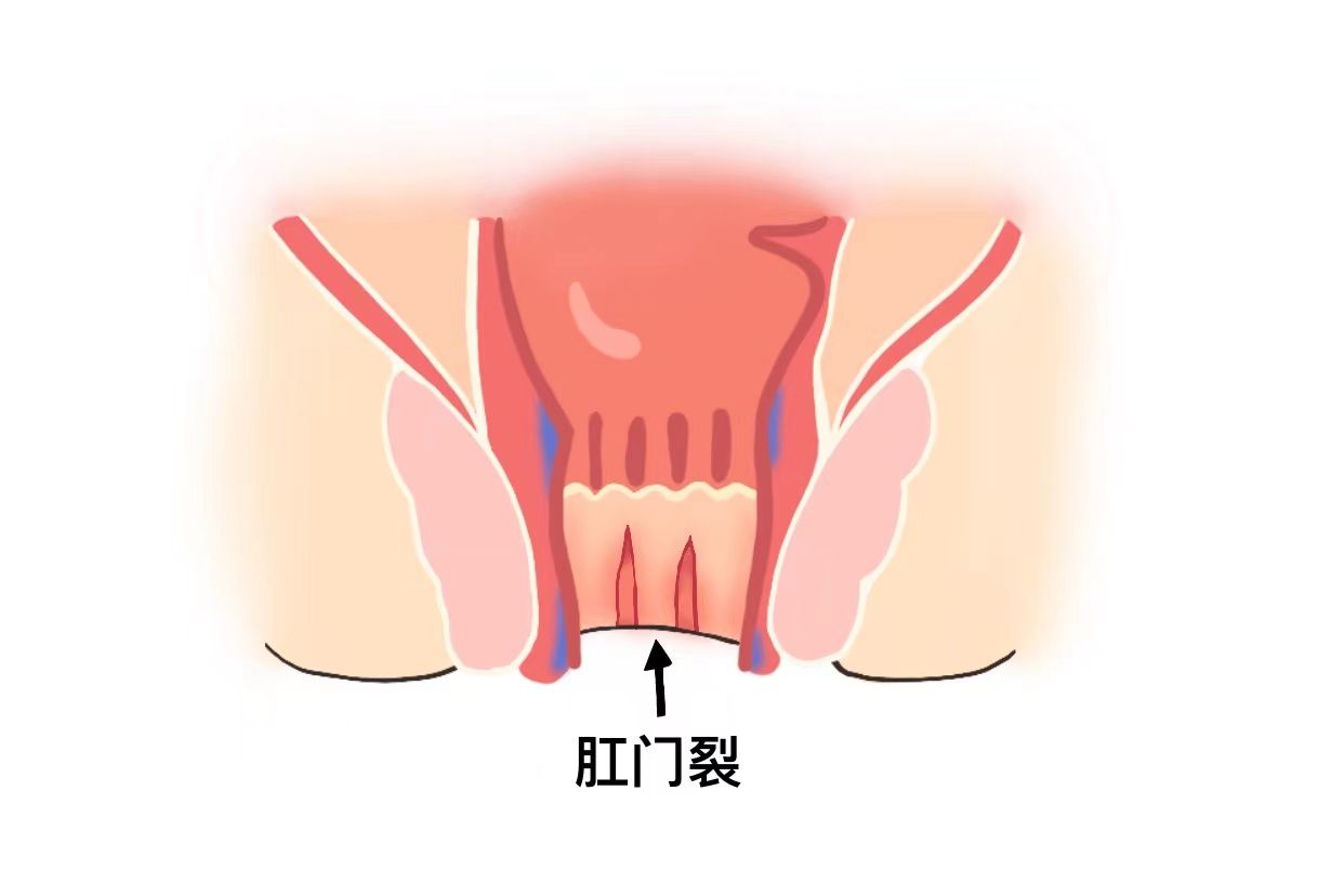 轻微肛裂图片早期图片