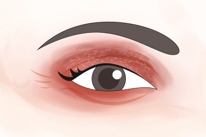过敏性眼睑皮炎图