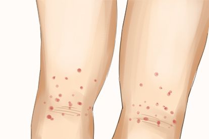 膝盖后面腿窝湿疹图片