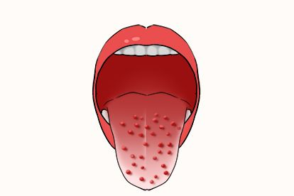 草莓舌头即草莓舌,一般见于由a型溶血性链球菌导致的急性呼吸道传染病