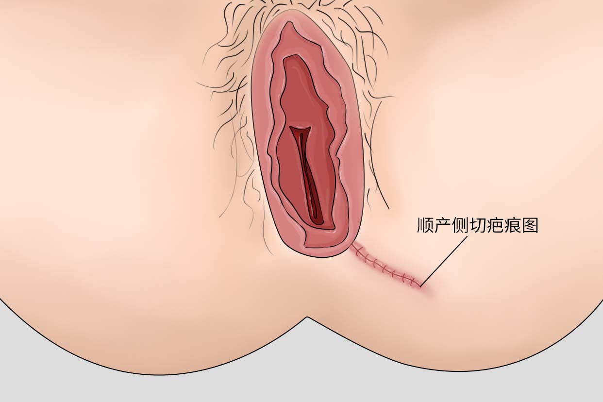 顺产侧切疤痕图片