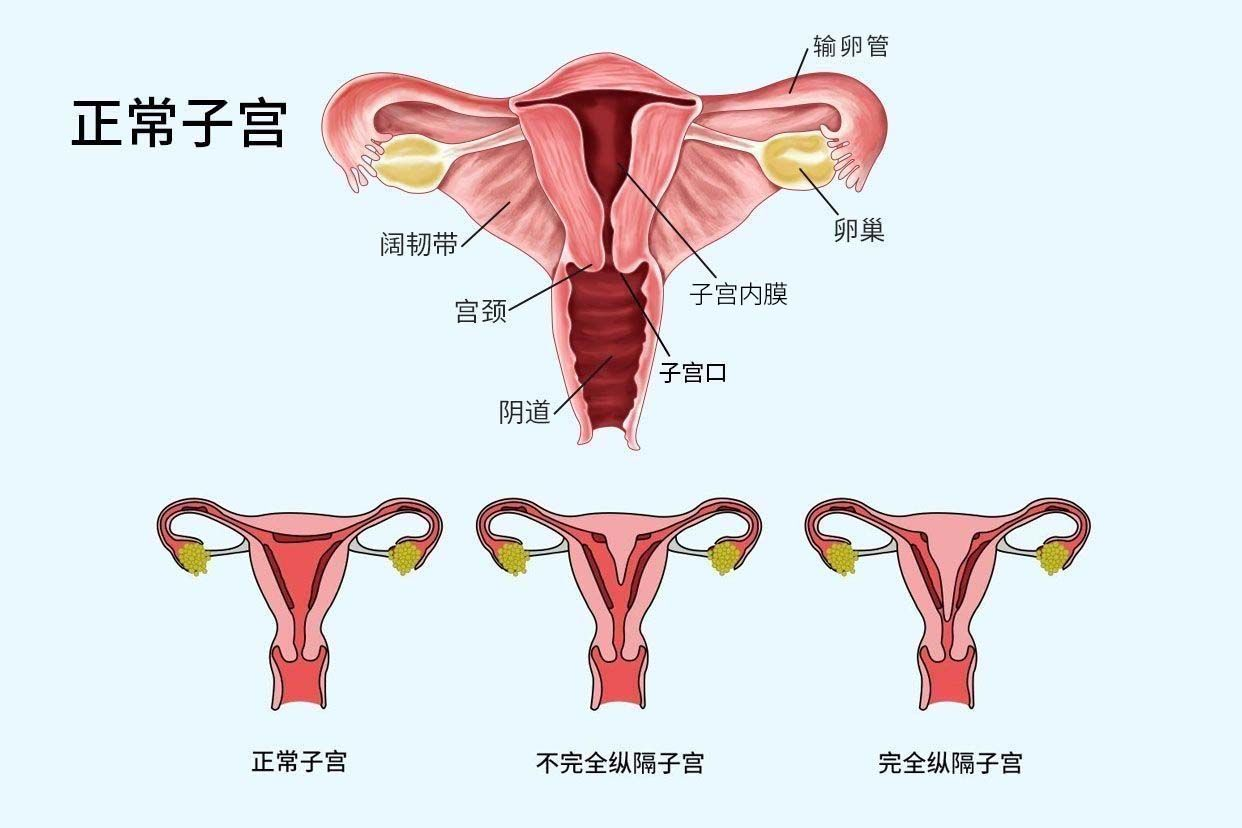 不全纵隔子宫y型图片图片