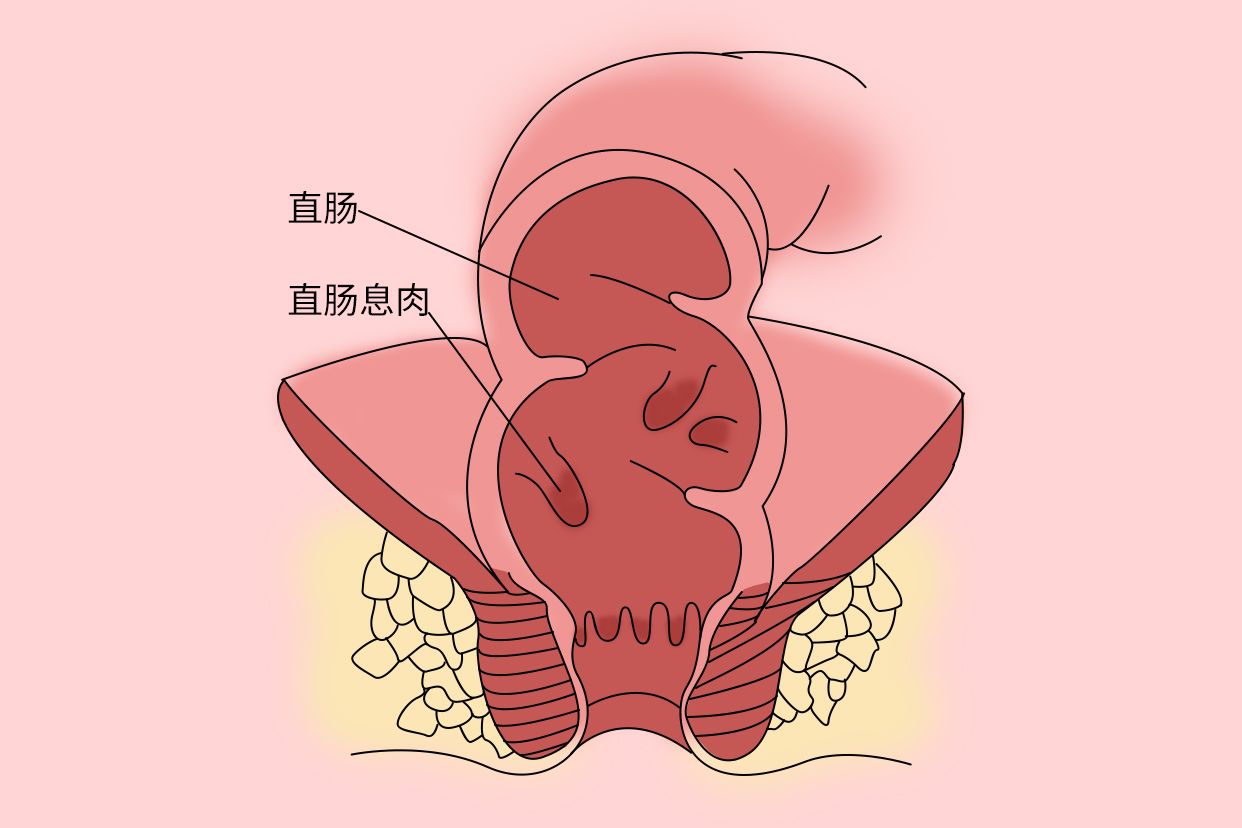 直肠息肉图片