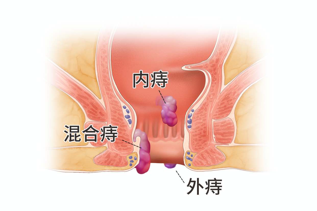 肛门正常与痔疮图片图片