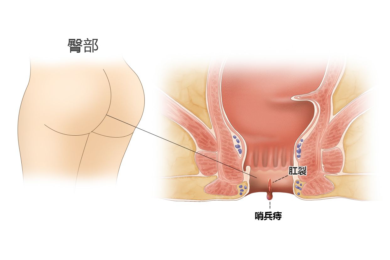 外痔圖