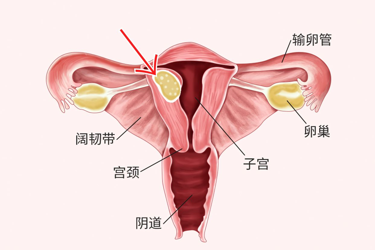 子宫囊肿图片