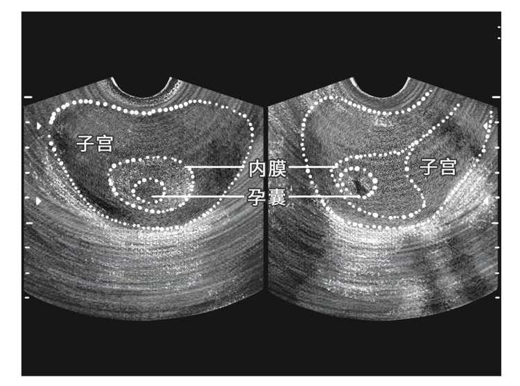 怀孕35天孕囊大小图片