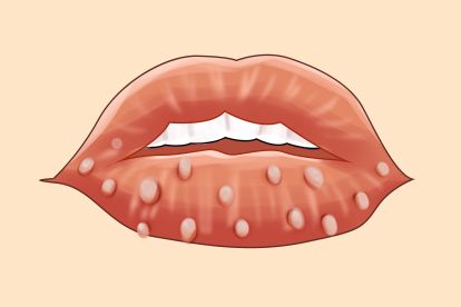 患者嘴唇感染hpv病毒后可能会表现为嘴唇有疣体生长,呈单个或多个密集