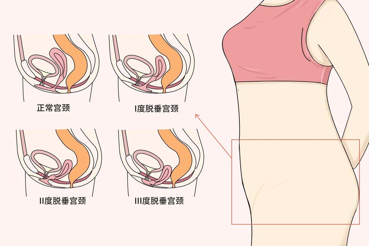 宫颈下垂一般是指子宫脱垂,子宫从正常位置沿阴道下降,部分或全部脱出