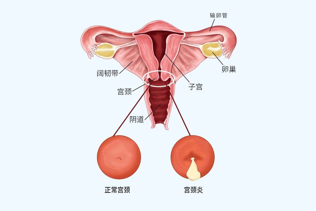 宫颈炎和正常的宫颈图