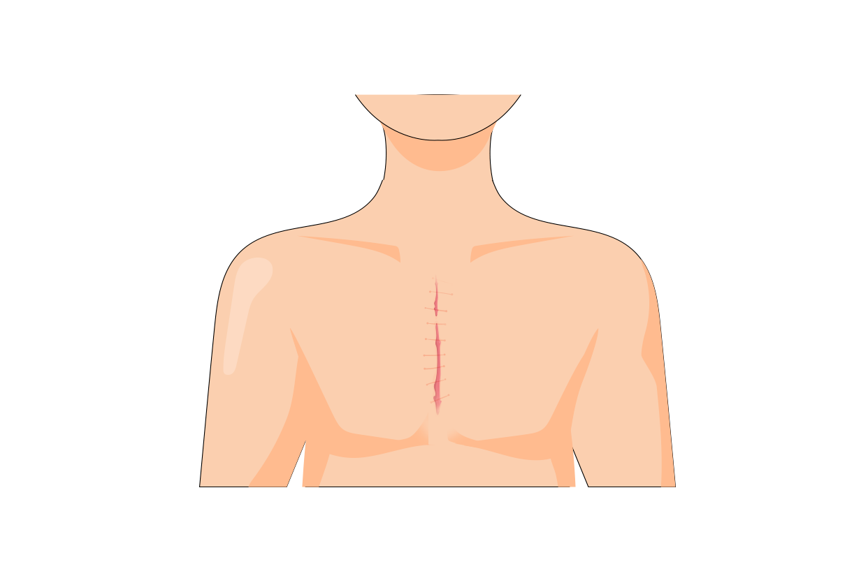 心臟手術疤痕圖片