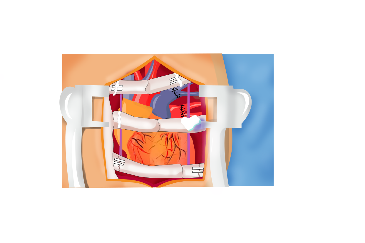 心脏手术怎么开胸图片图片