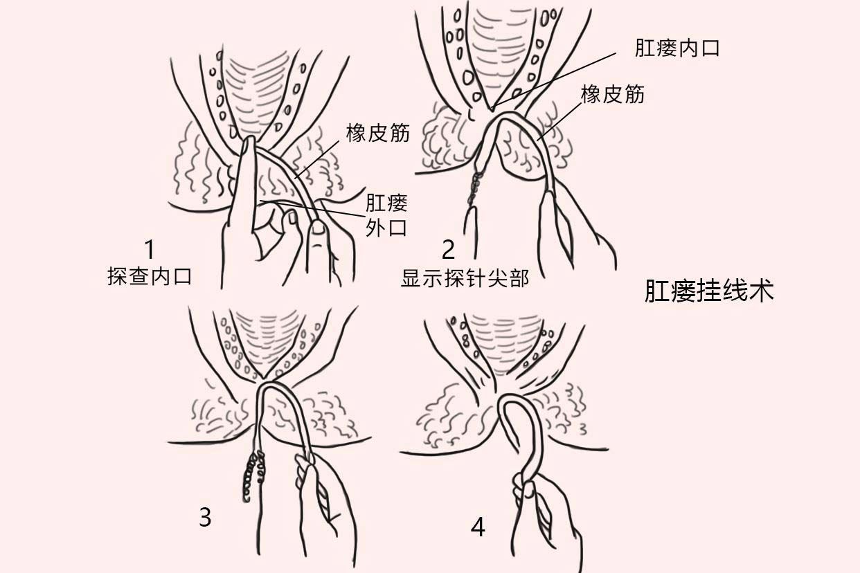 肛瘘挂线手术示意图图片