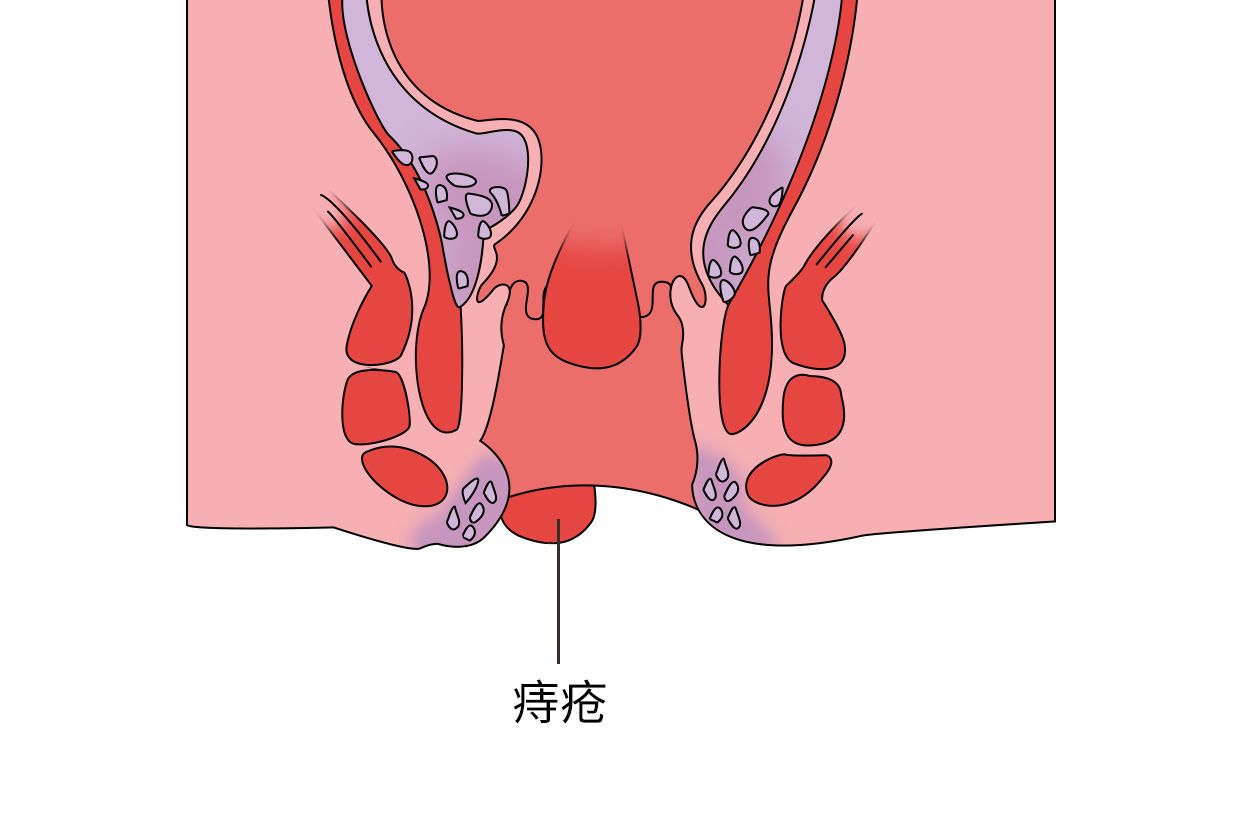 肛门有个小肉柱图片图片