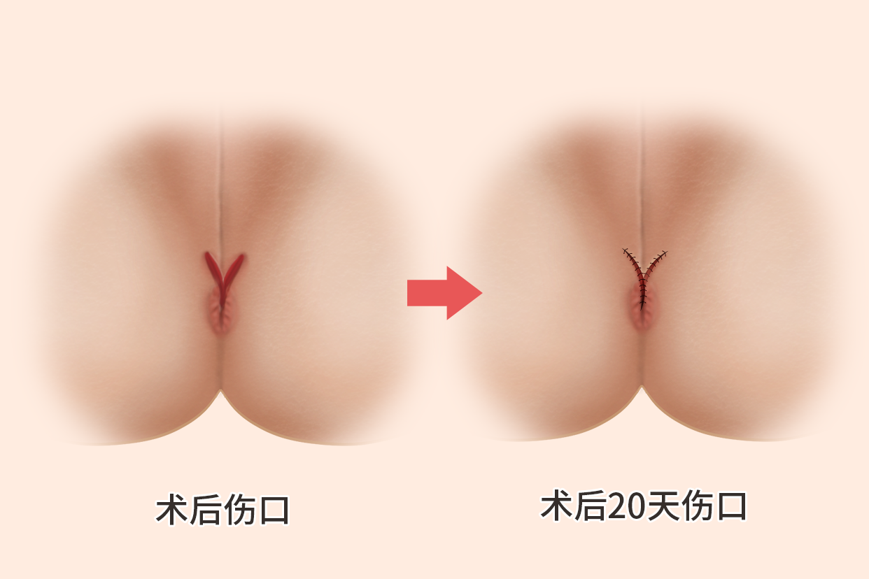 肛裂术后20天伤口图