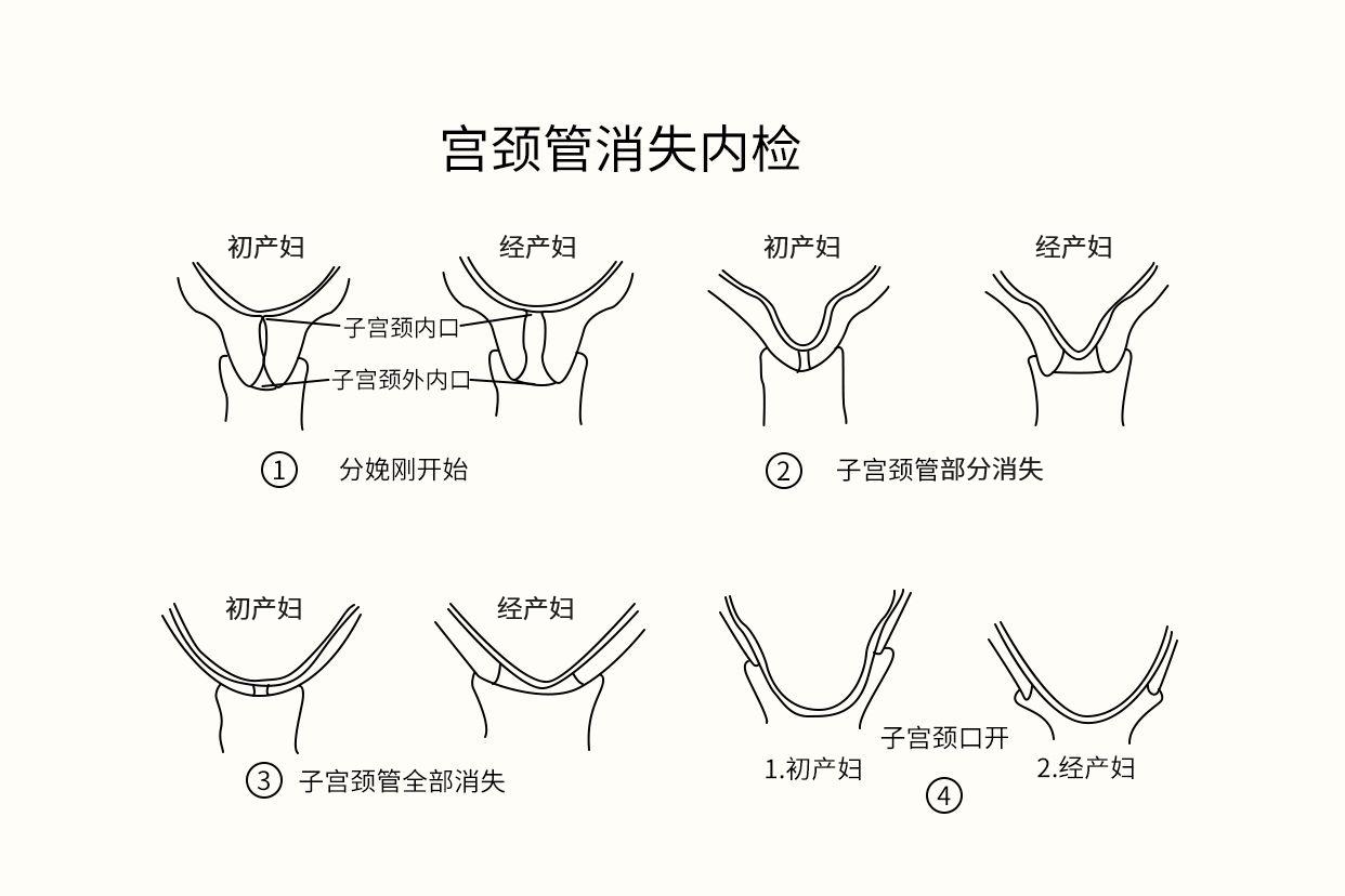 宫颈管消失内检图