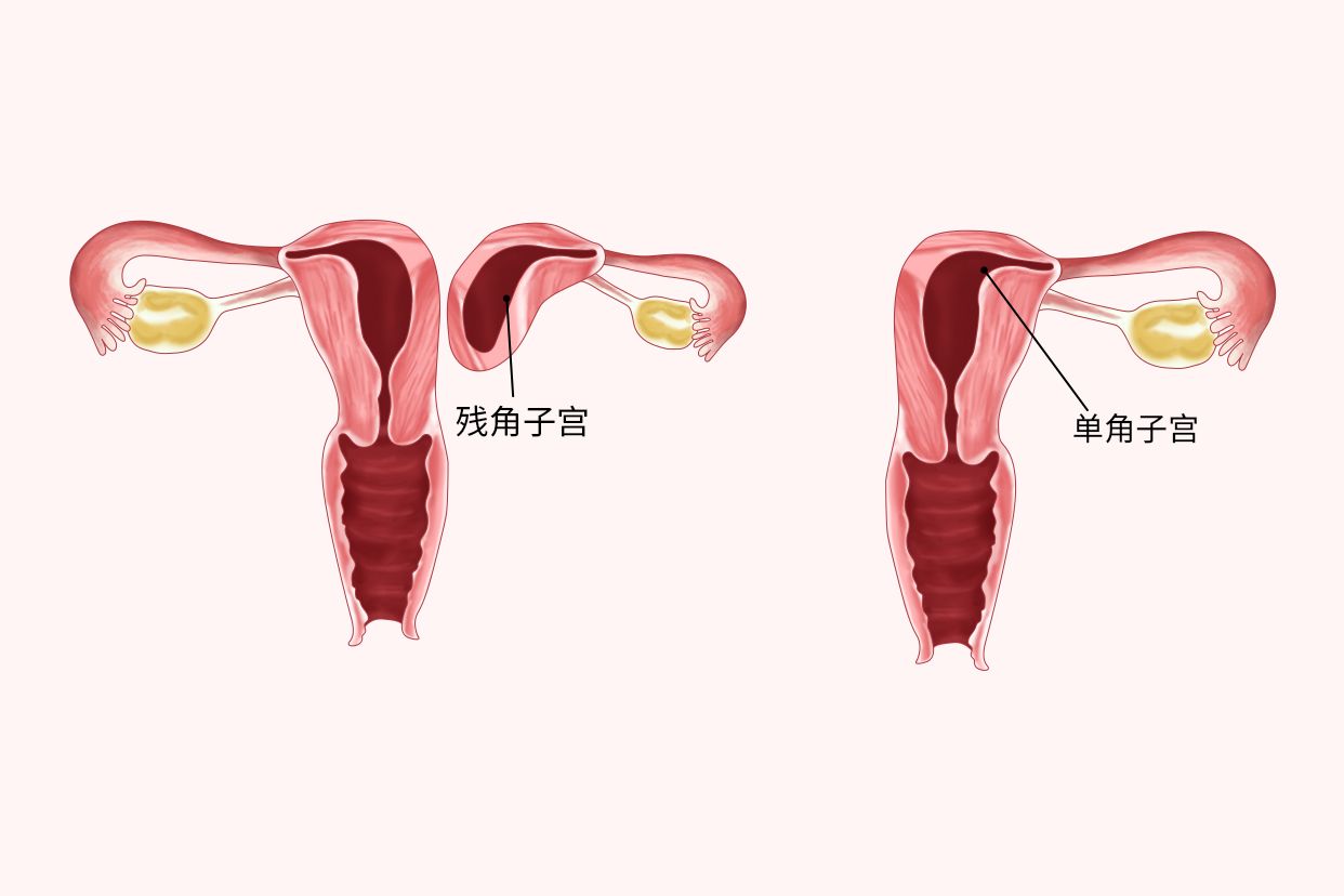 子宫畸形图片