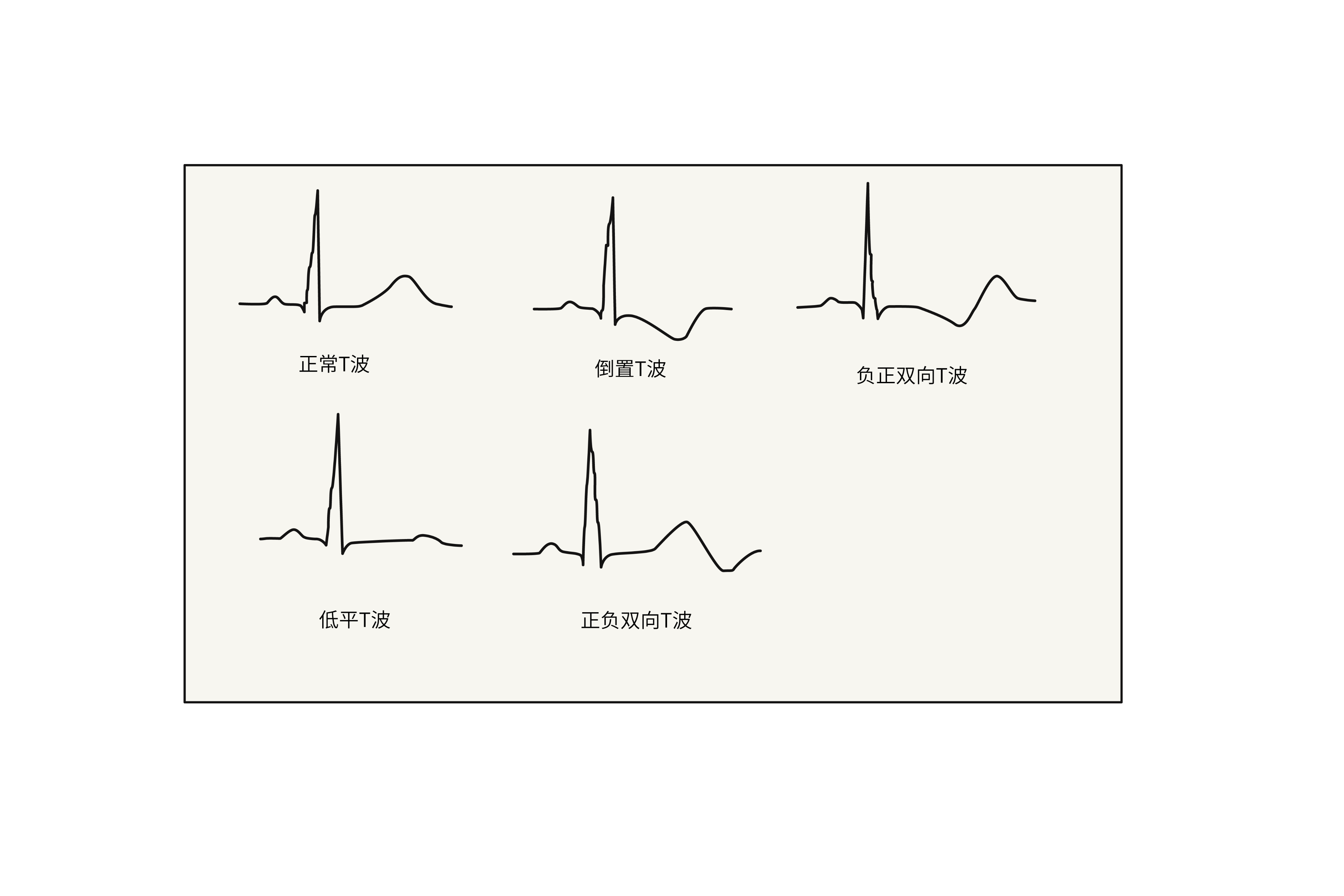 心电图t波异常图片
