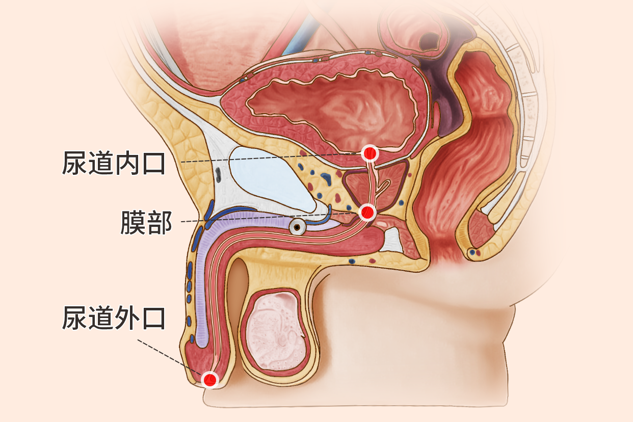 尿道口狭窄的症状图片图片