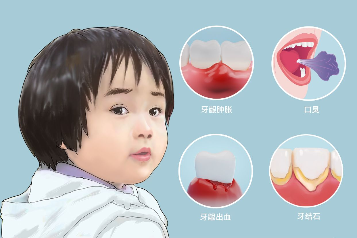 儿童牙结石图片
