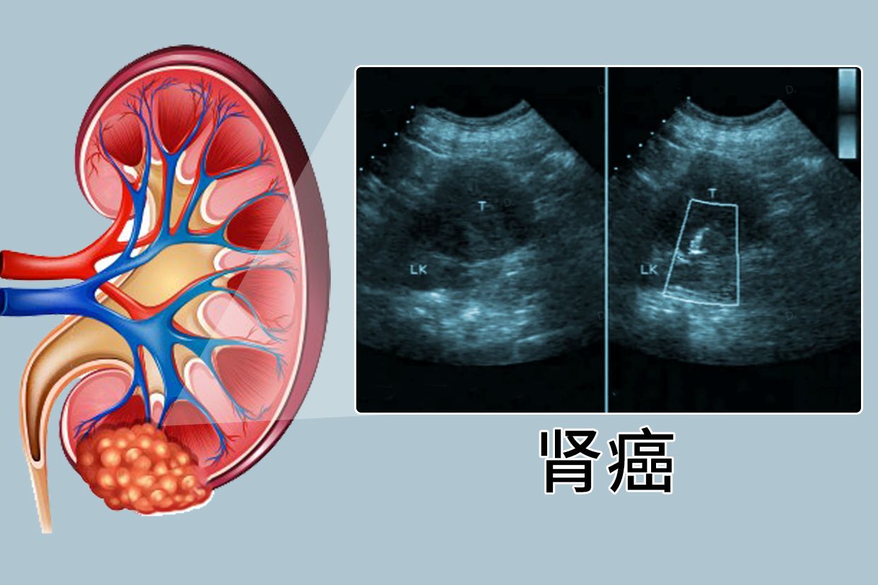 肾癌超声图片