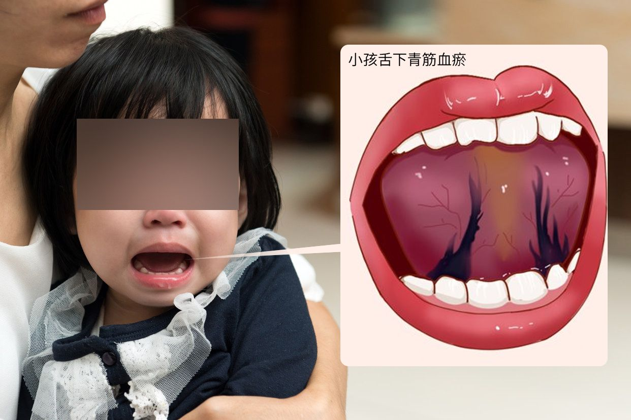 小孩舌下青筋血瘀图