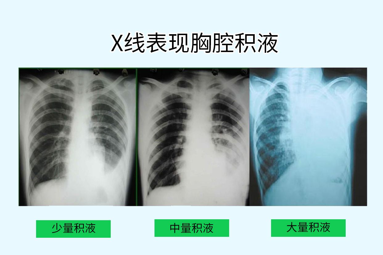 胸腔积液X线胸片图