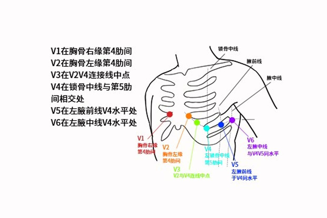 六个胸导联位置图片