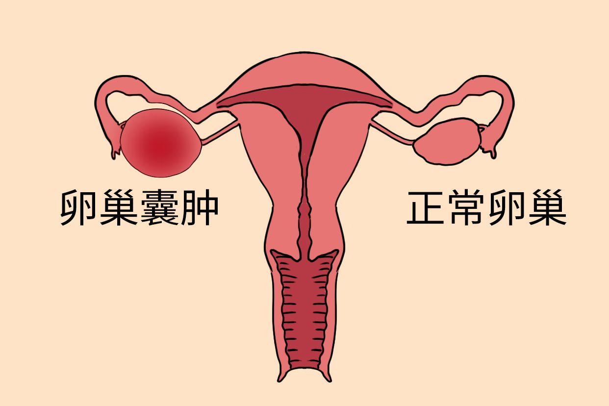 卵巢囊肿图