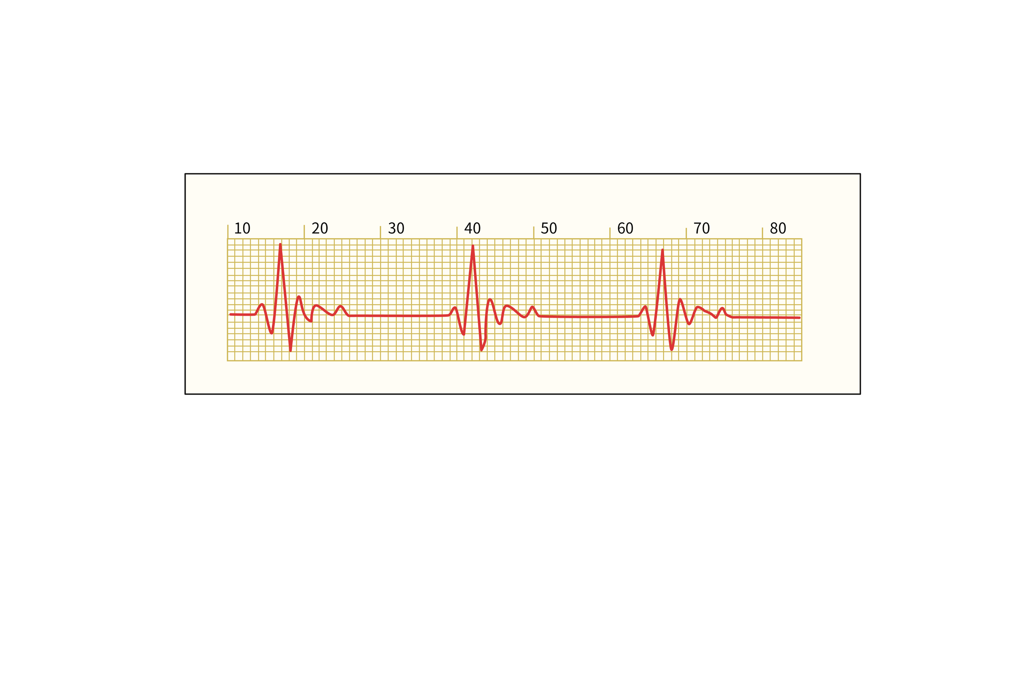 心电图M波型图
