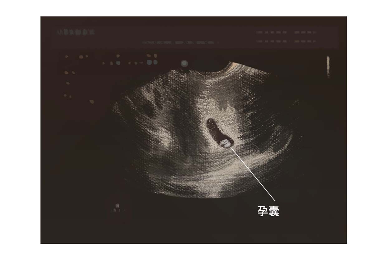 孕囊大小与孕周对照表/公式 - 准确看出胎儿发育情况 - 姐妹邦