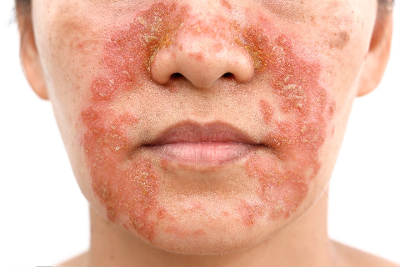 皮脂炎一般是指脂溢性皮炎,典型的皮肤损害为黄红色斑片,上面附着油腻