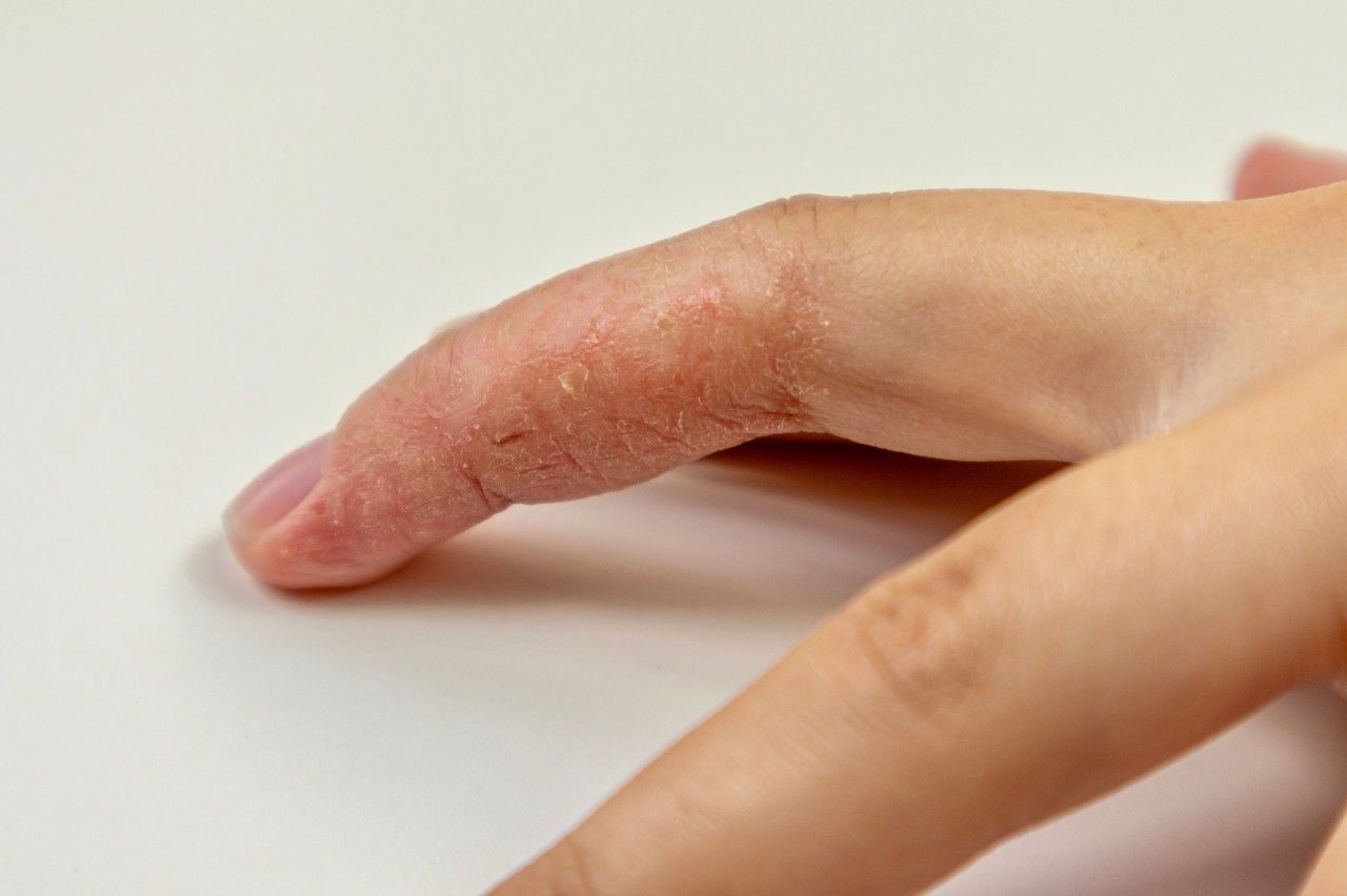手指皲裂性湿疹图片