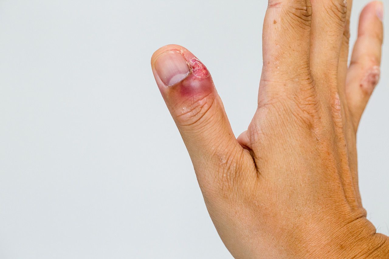 手指甲沟炎症状图片