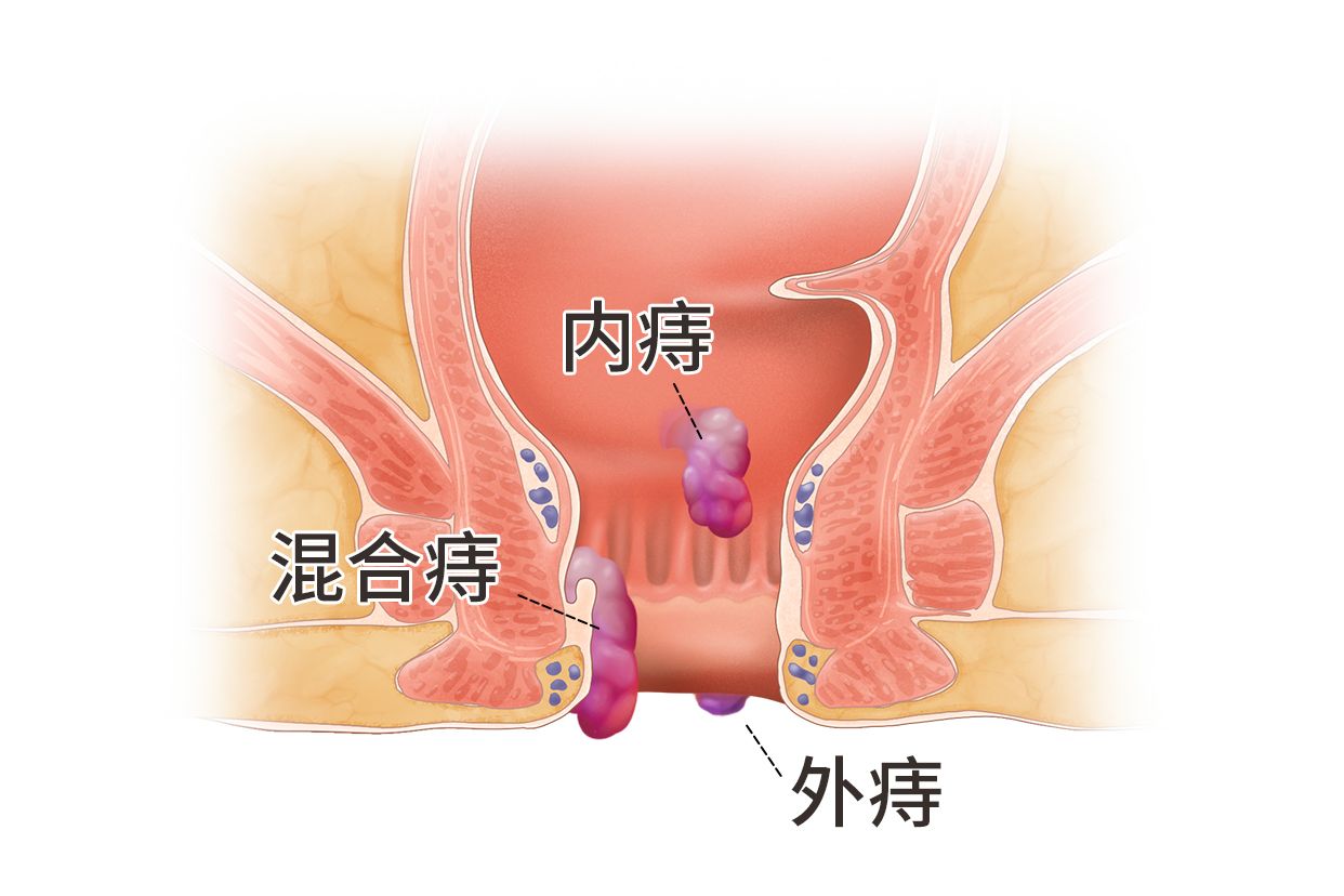 混合痔疮