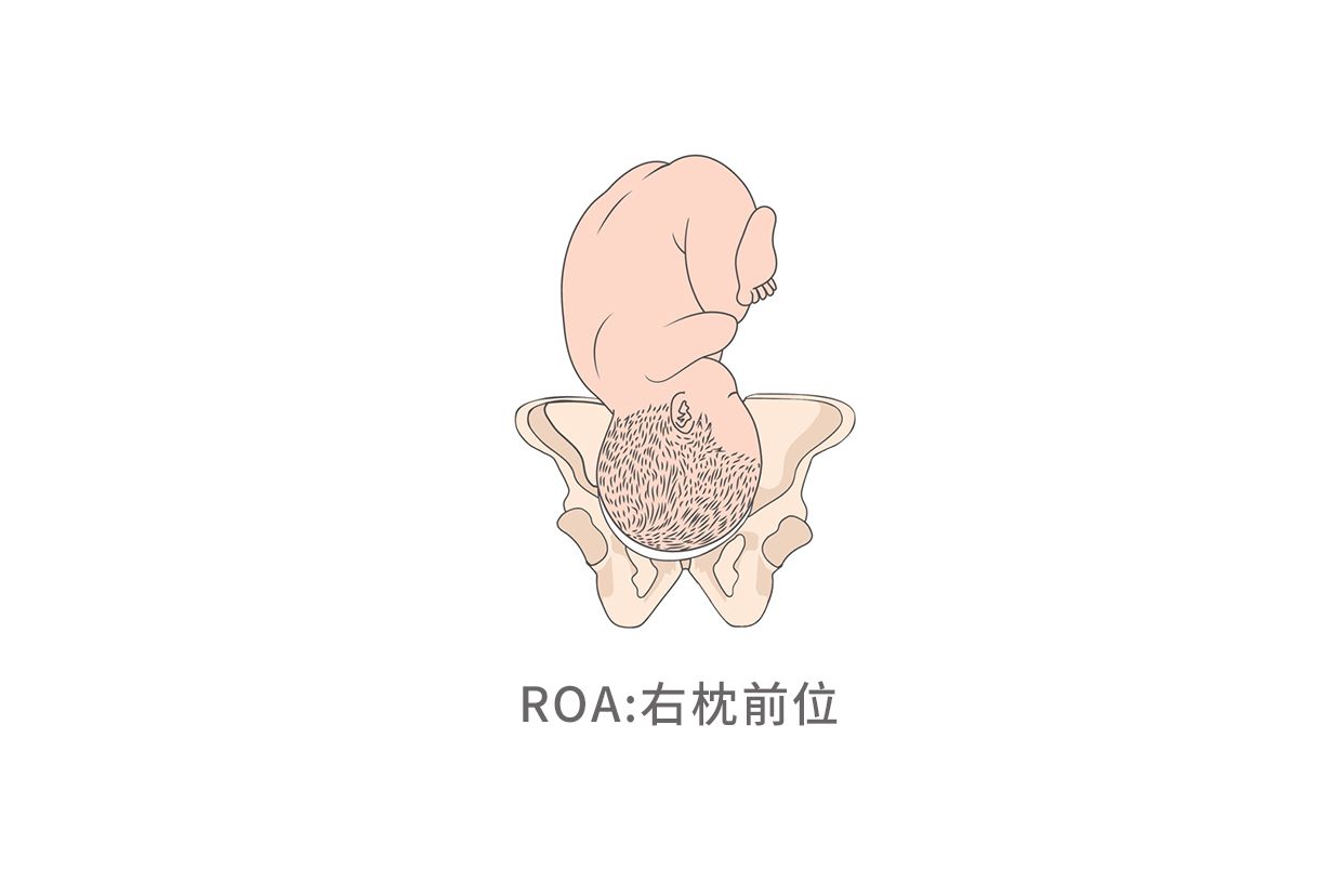 胎位rsa显示图图片