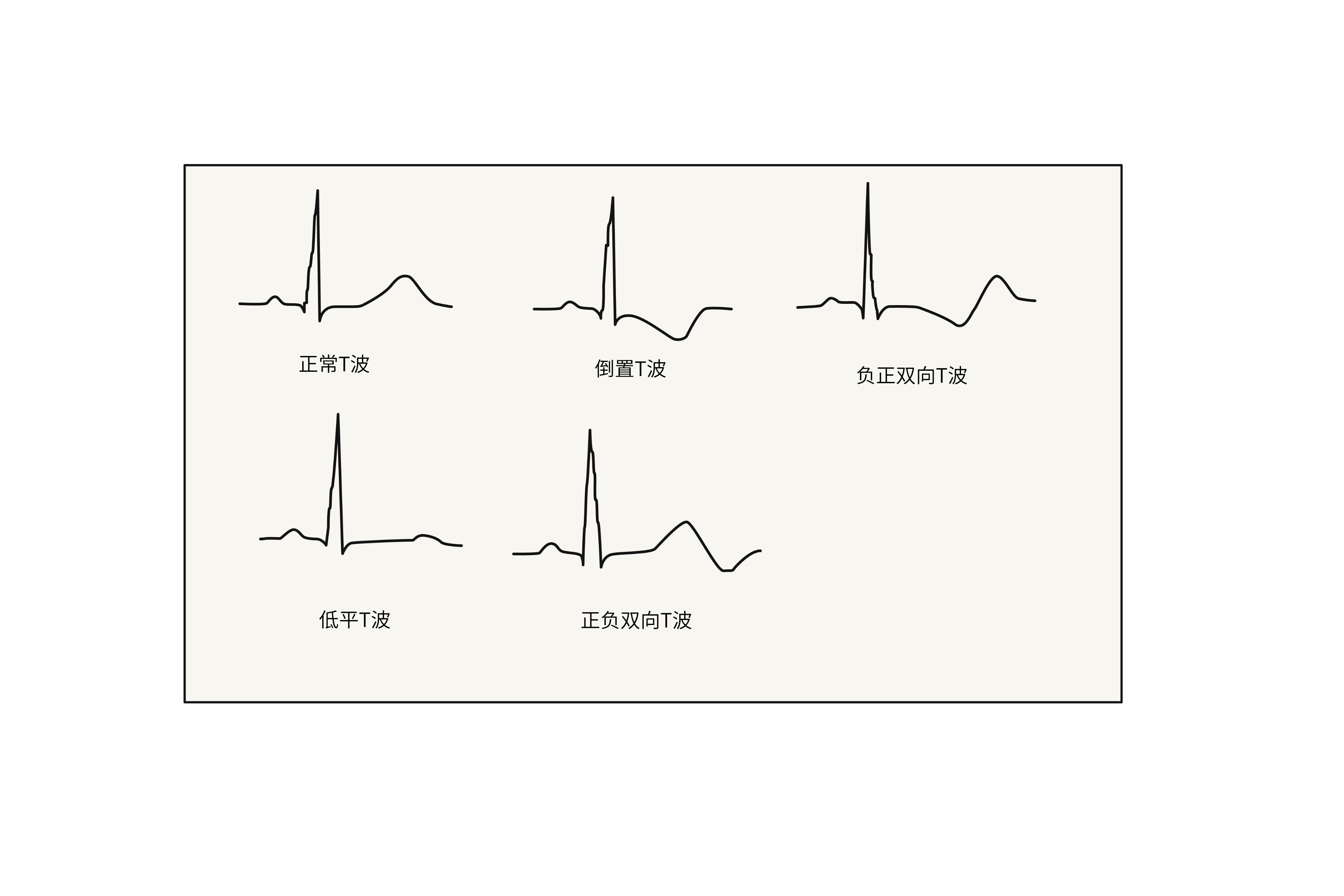 第一节 正常心电图的波形及各波的意义-临床心电图学-医学