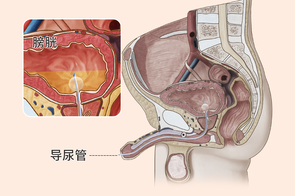 三腔导尿管连接图图片