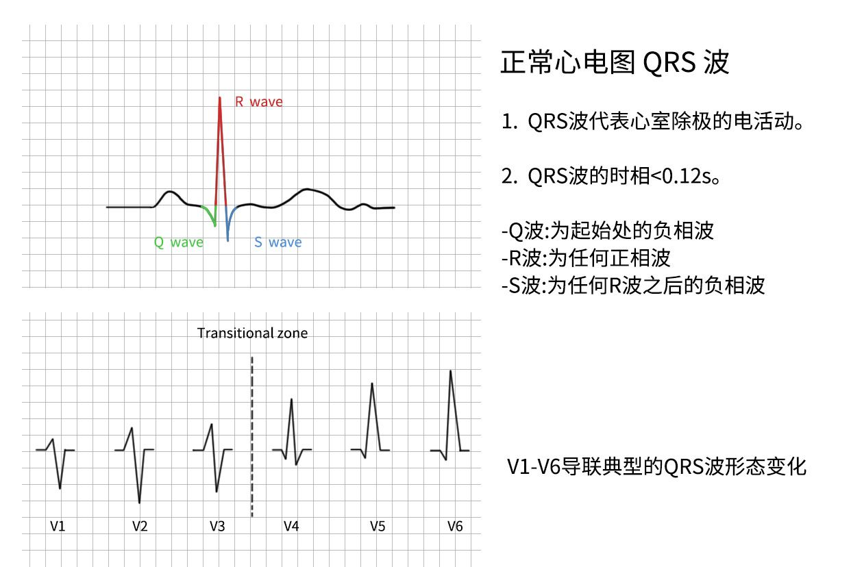 正常QRS波
