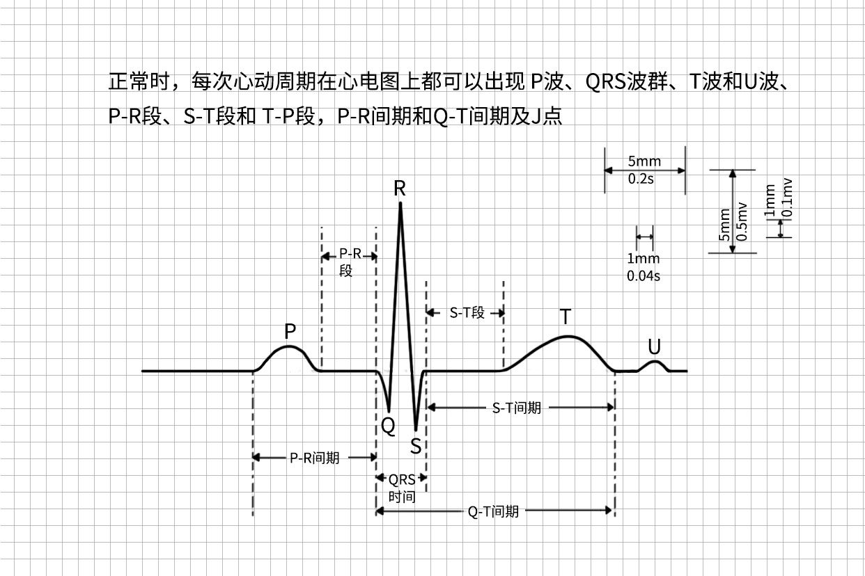 二、二尖瓣型P波(图1-358～1-359)-心血管-医学