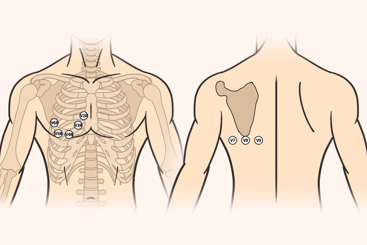 胸骨导联位置示意图图片