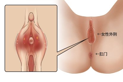 女性尿道口红肿图