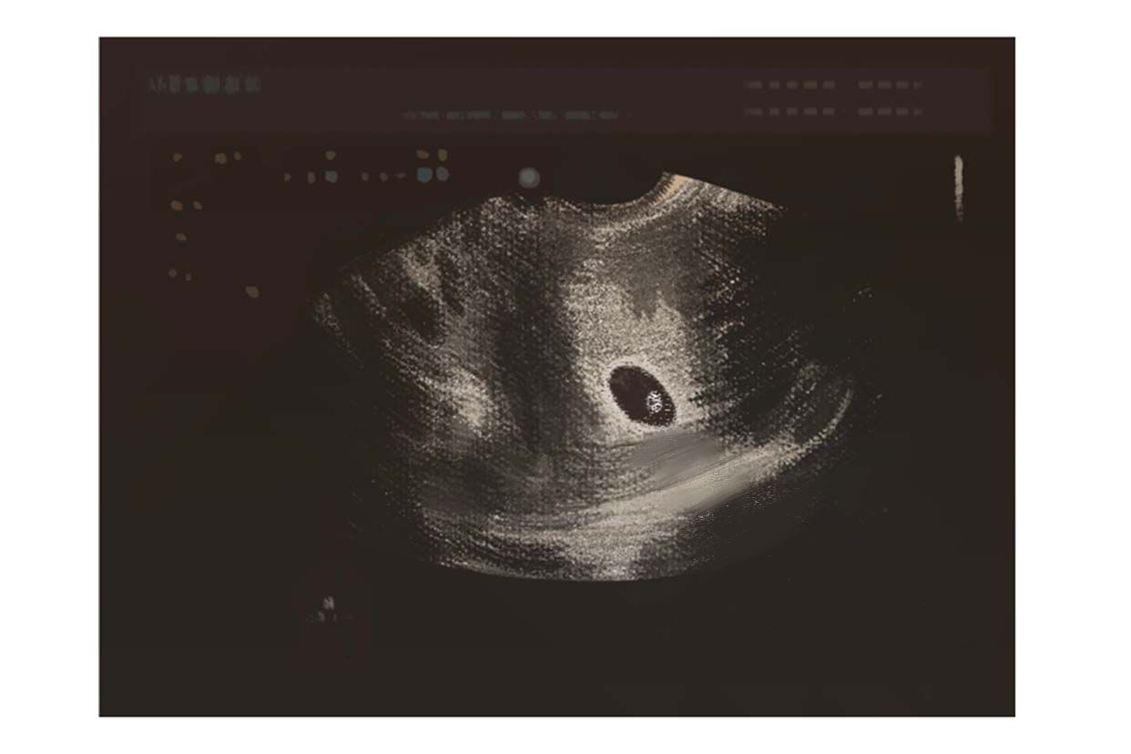 怀孕六周孕囊图片图片