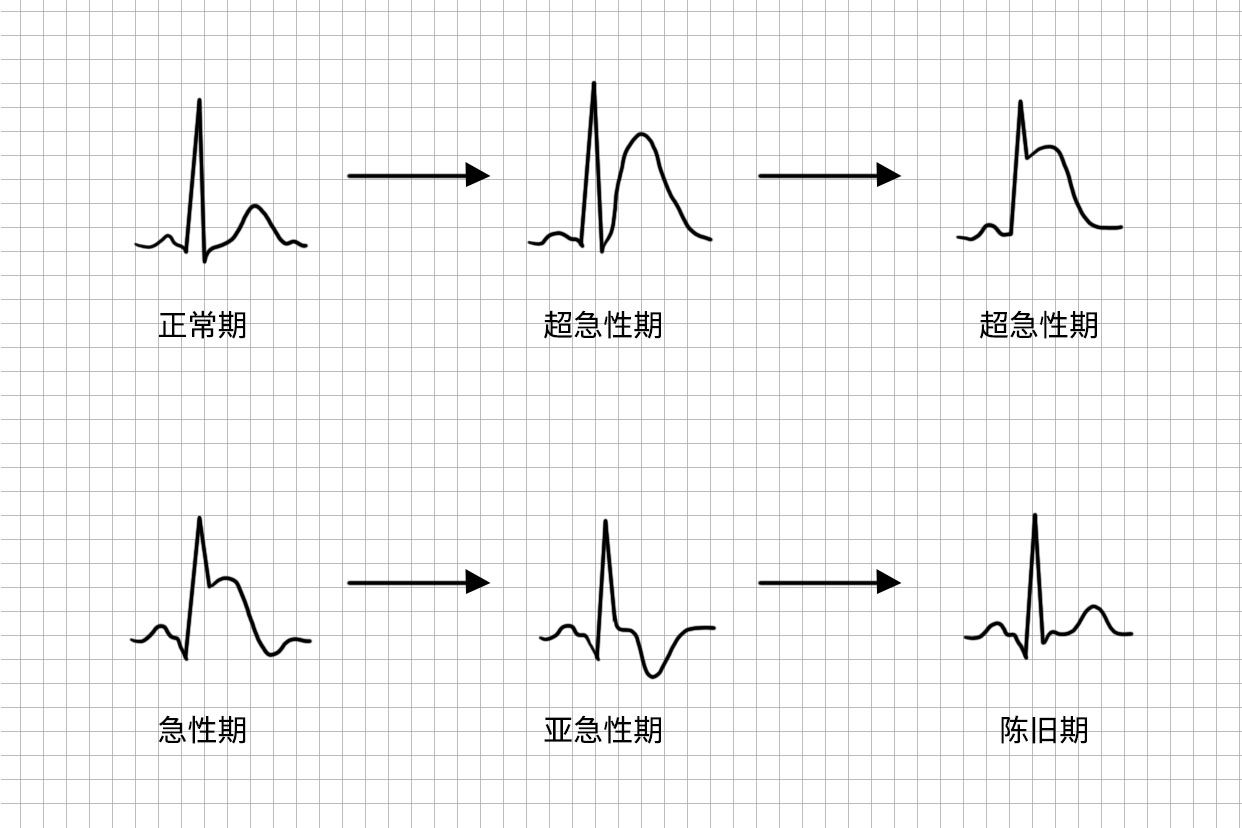 心电图t波高耸指t波异常高尖