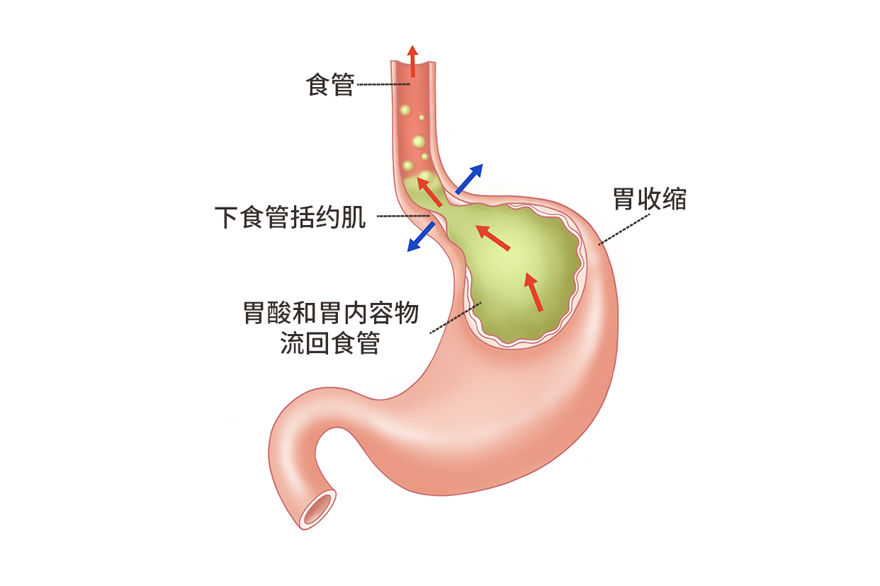 胃食管反流病图