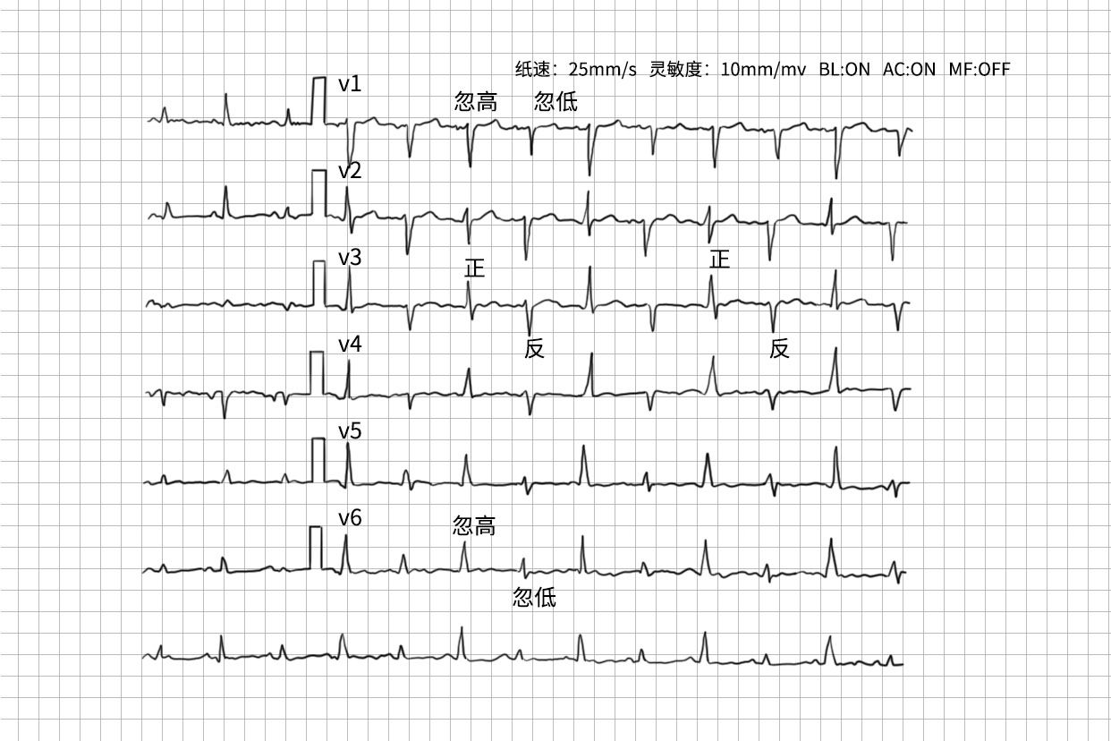 心包积液心电图图片