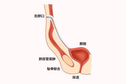 脐尿管瘘ppt图片