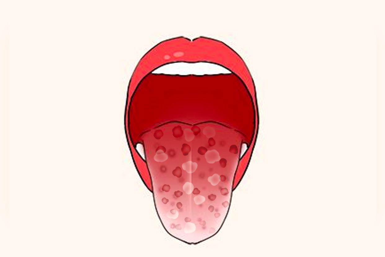 梅毒舌头图片